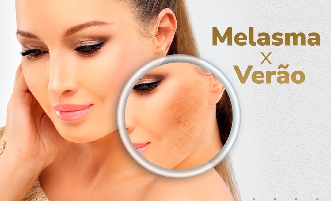 Melasma e o Verão