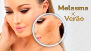 Melasma e o Verão